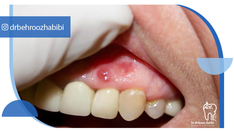 عفونت لثه