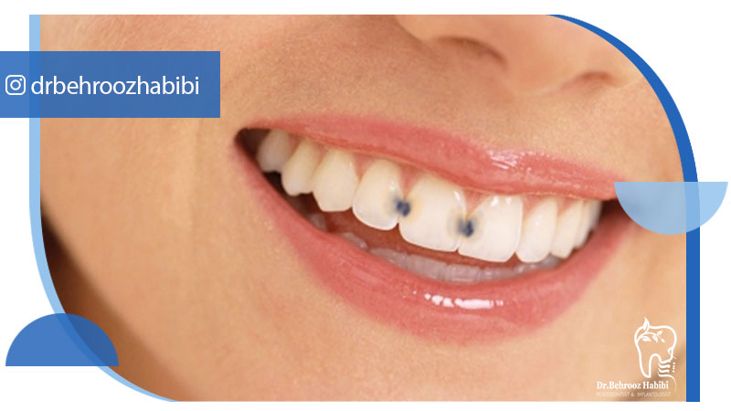 پوسیدگی دندان