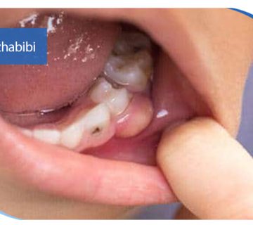 پیوند استخوان در تهران