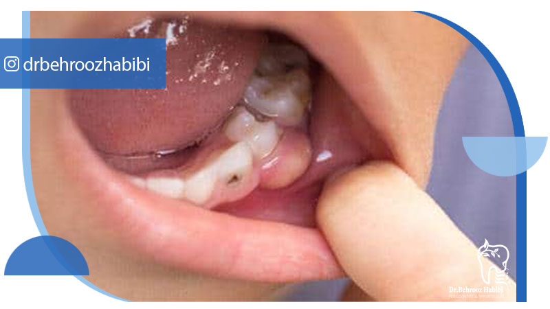 پیوند استخوان در تهران