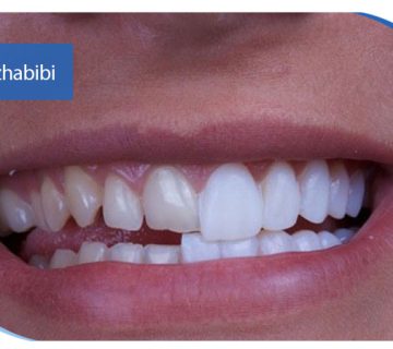 کامپوزیت دندان در تهران