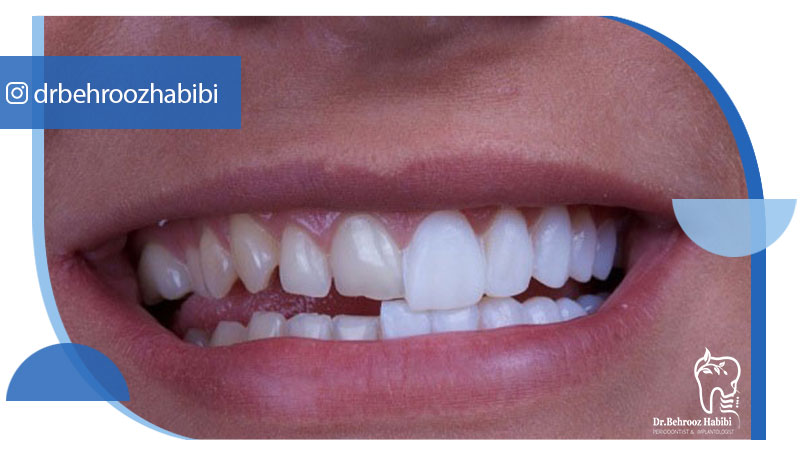 کامپوزیت دندان در تهران